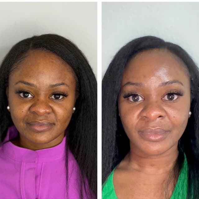 Aura Skin Reset at Aura Vitale Med Spa in Arlington, TX